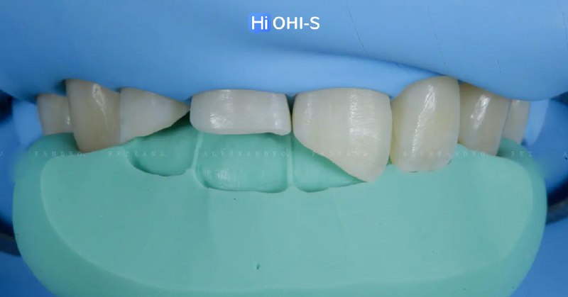 International Schools Working with Composite Restorations