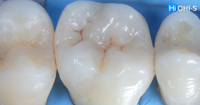 International Schools Working with Composite Restorations