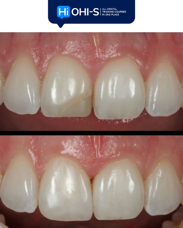 Anterior Veneers: Digital Manufacturing Protocols for Functional and Aesthetic Restorations