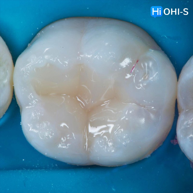 International Schools Working with Composite Restorations