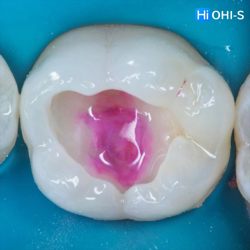International Schools Working with Composite Restorations