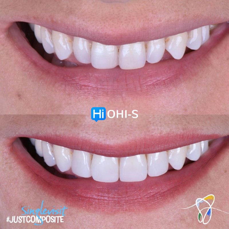 Composite Veneers, All Restorative Techniques