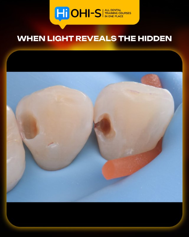 International Schools Working with Composite Restorations