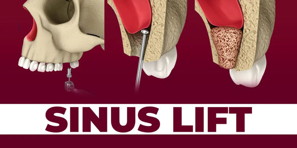Predictable Sinus Lift