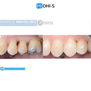 Bioclear Dental Restoration