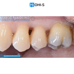 Bioclear Dental Restoration