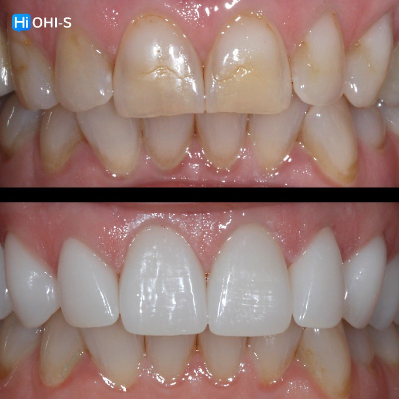 Anterior Veneers: Digital Manufacturing Protocols for Functional and Aesthetic Restorations