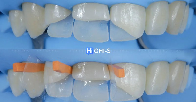 International Schools Working with Composite Restorations