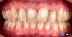 Ceramic Layering: Protocols of the World’s Leading Schools