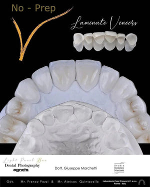 Ceramic Restorations: Veneers, Inlays, Crowns