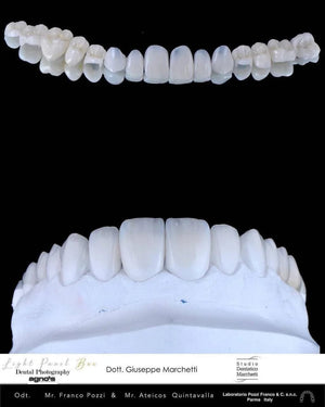 Ceramic Restorations: Veneers, Inlays, Crowns