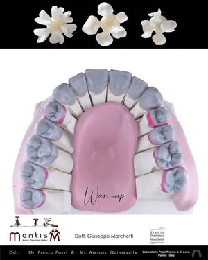 Ceramic Restorations: Veneers, Inlays, Crowns