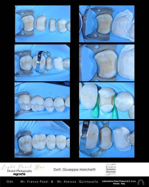 Ceramic Restorations: Veneers, Inlays, Crowns