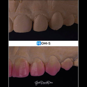 Composite Veneers, All Restorative Techniques