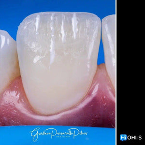 Composite Veneers, All Restorative Techniques