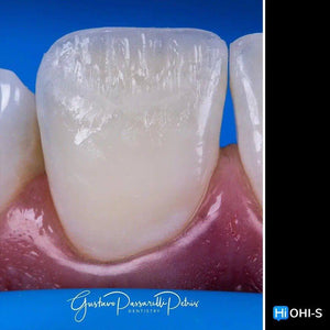 Composite Veneers, All Restorative Techniques