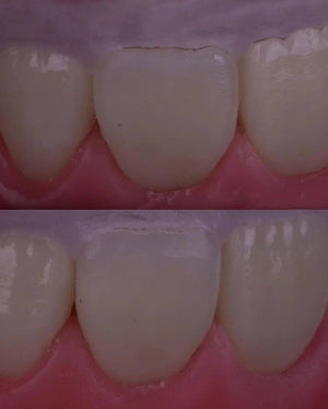 Composite Veneers, All Restorative Techniques