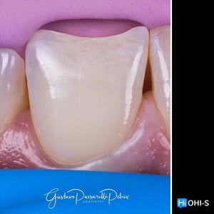 Composite Veneers, All Restorative Techniques