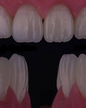 Composite Veneers, All Restorative Techniques