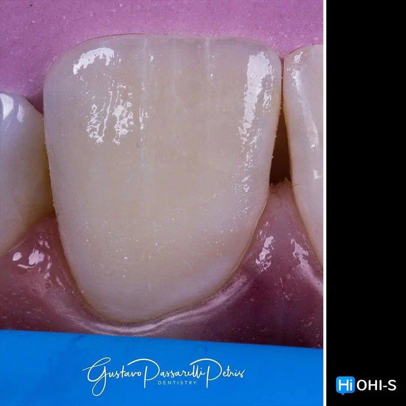 Composite Veneers, All Restorative Techniques