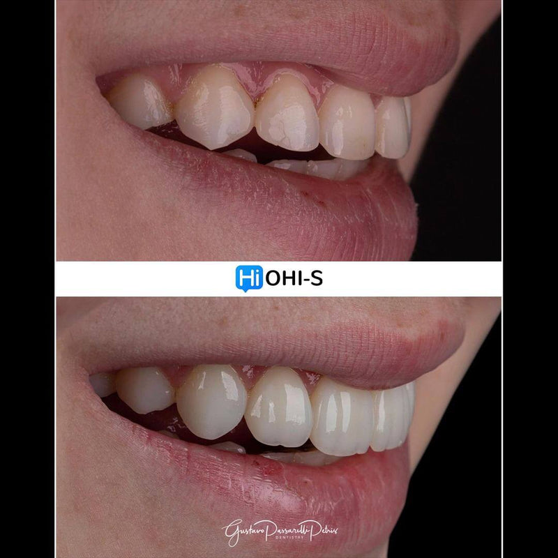 Composite Veneers, All Restorative Techniques