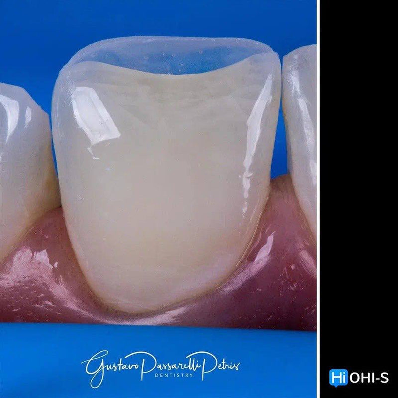 Composite Veneers, All Restorative Techniques