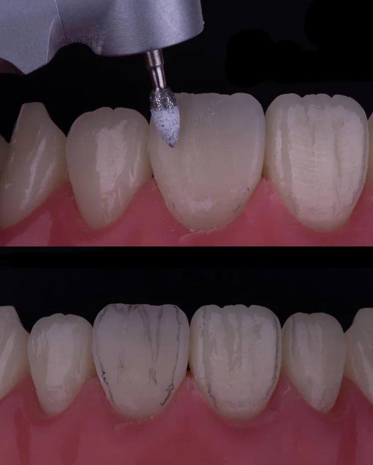 Composite Veneers, All Restorative Techniques