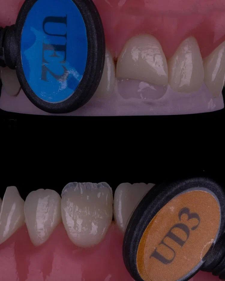 Composite Veneers, All Restorative Techniques