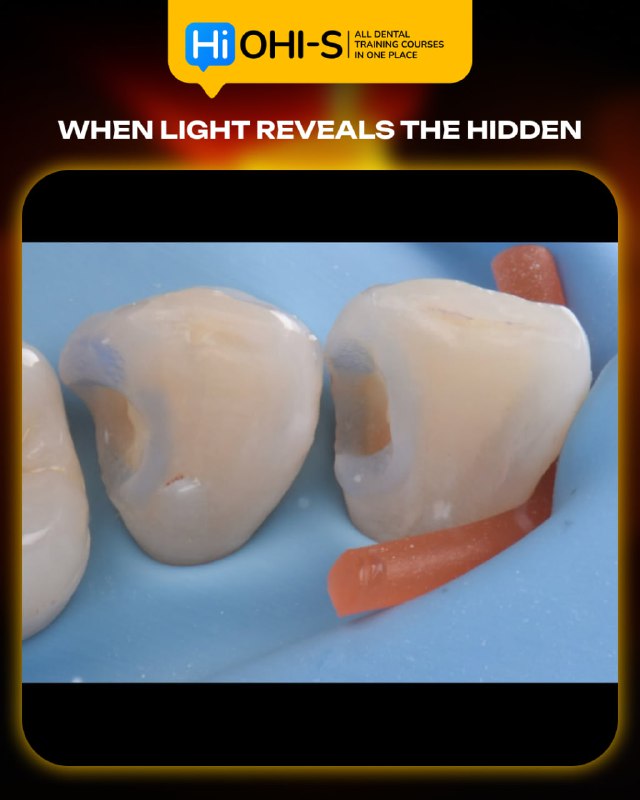 International Schools Working with Composite Restorations
