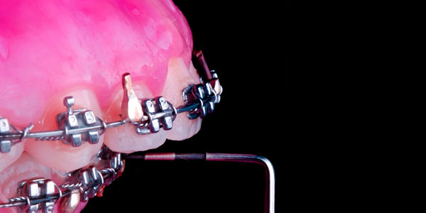 Missing Lateral Incisors and Bony deficiencies