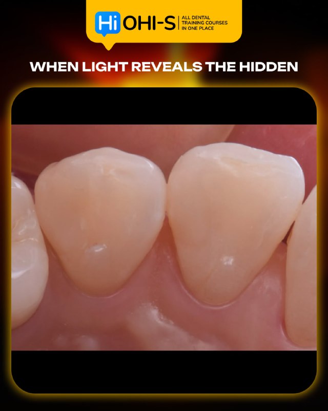 International Schools Working with Composite Restorations
