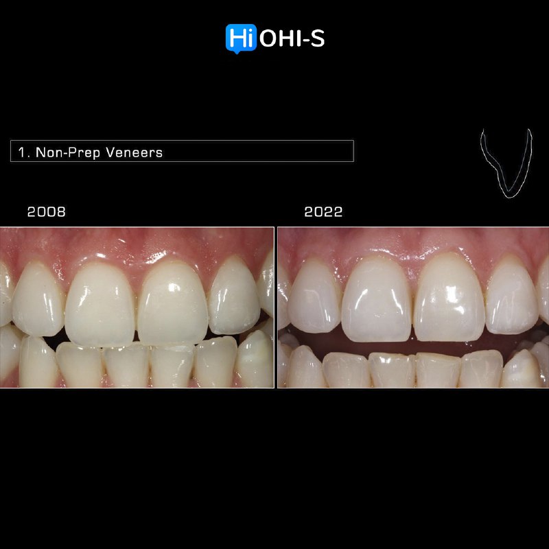 Anterior Veneers: Digital Manufacturing Protocols for Functional and Aesthetic Restorations