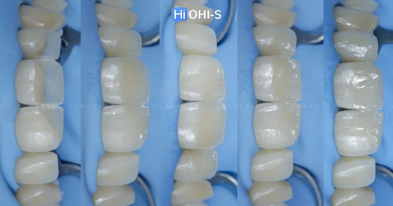 International Schools Working with Composite Restorations