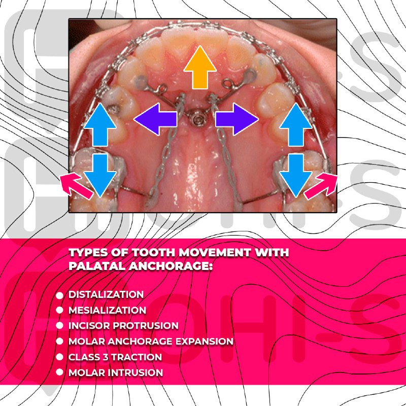 Challenging orthodontic cases: the use of skeletal anchorage