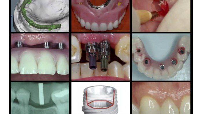 gIDE Dental A-Z in Restorative Implant Dentistry (CME VIDEOS) By: George Perri