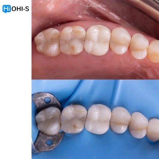 The Biomimetic Concept: Composite Restoration Protocols