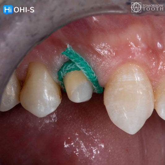 Vertical Preparation Protocols: The Complete Guide in 24 Lessons from Tomorrow Tooth