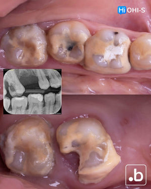 The Biomimetic Concept: Composite Restoration Protocols