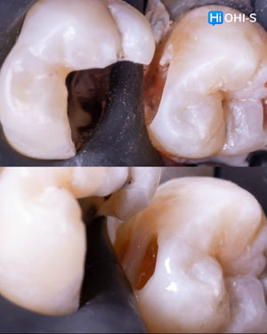 The Biomimetic Concept: Composite Restoration Protocols