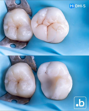 The Biomimetic Concept: Composite Restoration Protocols