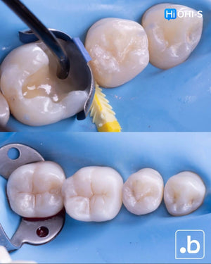 The Biomimetic Concept: Composite Restoration Protocols
