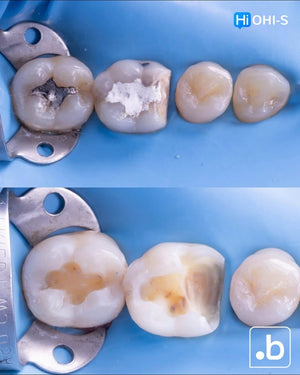 The Biomimetic Concept: Composite Restoration Protocols