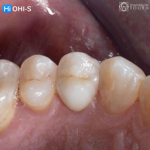 Vertical Preparation Protocols: The Complete Guide in 24 Lessons from Tomorrow Tooth