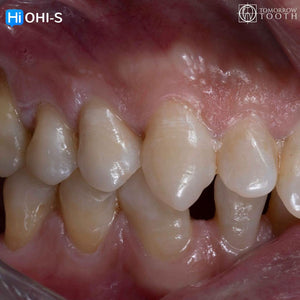 Vertical Preparation Protocols: The Complete Guide in 24 Lessons from Tomorrow Tooth