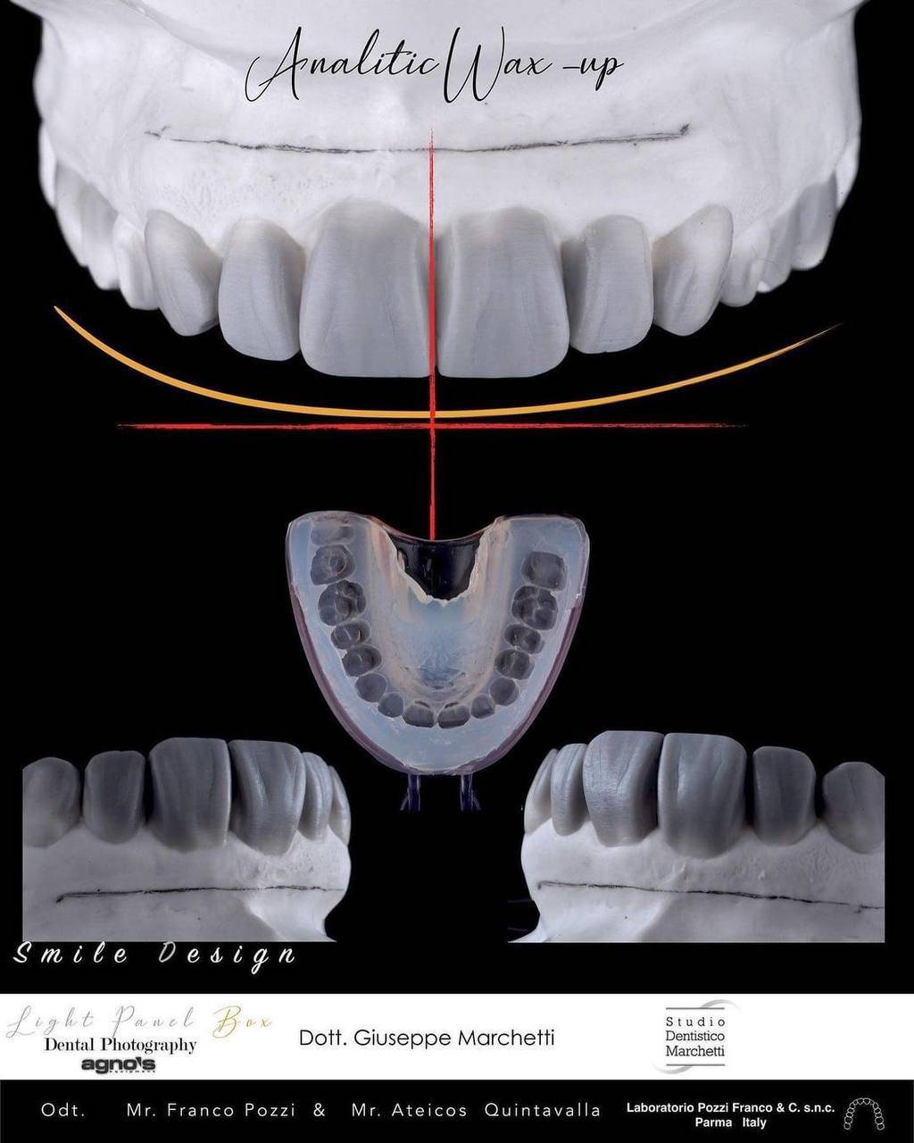 Analytic wax-up dental model showing upper and lower teeth with smile design and occlusion alignment