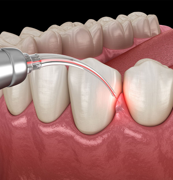 Laser in Dentistry