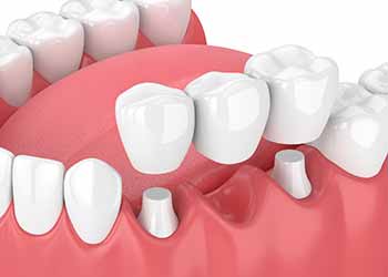 Prosthodontics