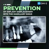 Predictable Sinus Lift