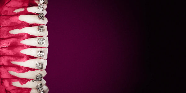 Is Orthognathic-Assisted Orthodontic Treatment Everything?
