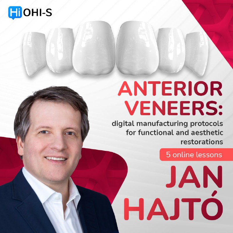 Anterior Veneers: Digital Manufacturing Protocols for Functional and Aesthetic Restorations